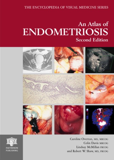 Overton Caroline Atlas Of Endometriosis 