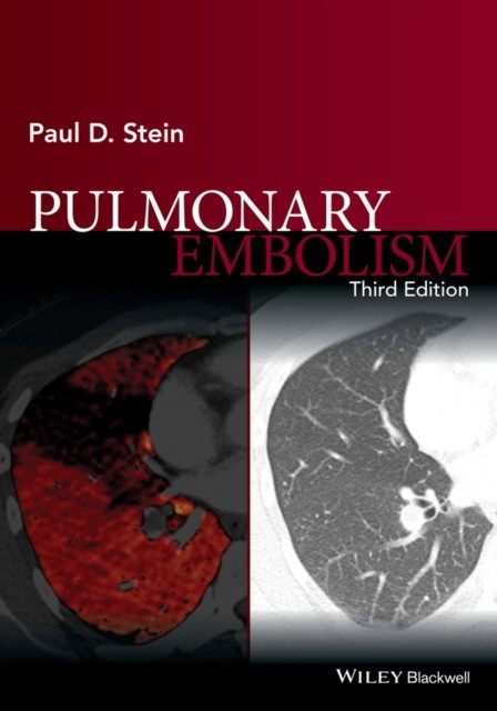 Paul D. Stein Pulmonary Embolism 