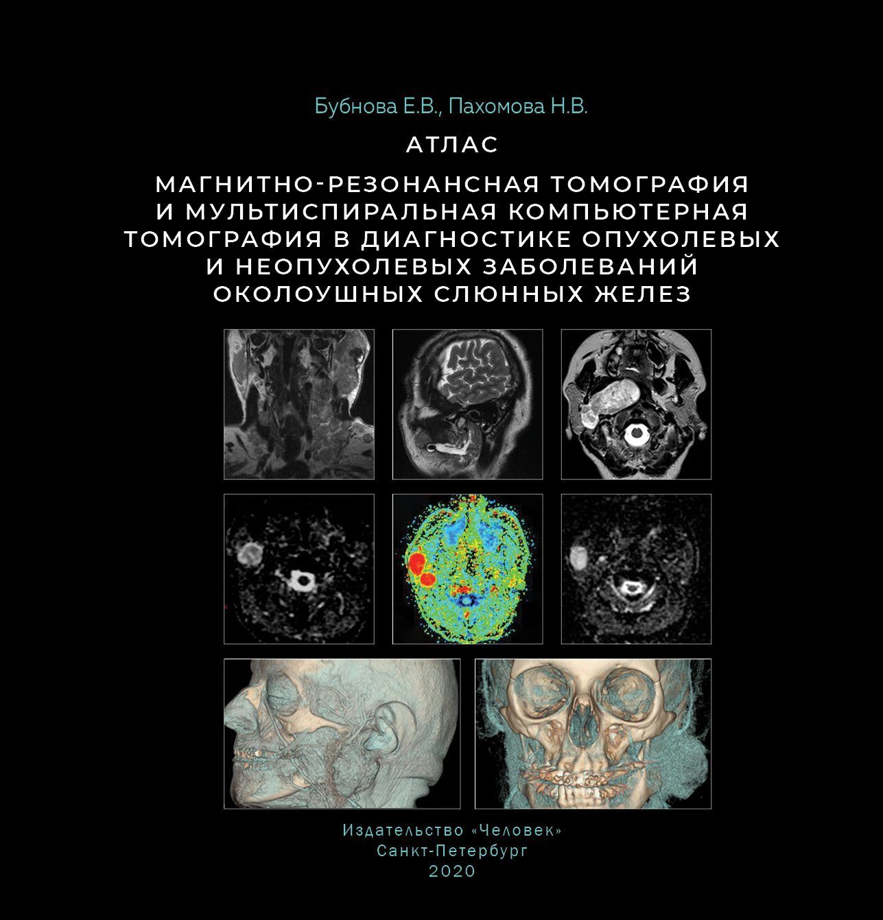 Пахомова Н.В., Бубнова Е.В. - Магнитно-резонансная томография и мультиспиральная компьютерная томография в диагностике опухолевых и неопухолевых заболеваний околоушных слюнных желез. Атлас 