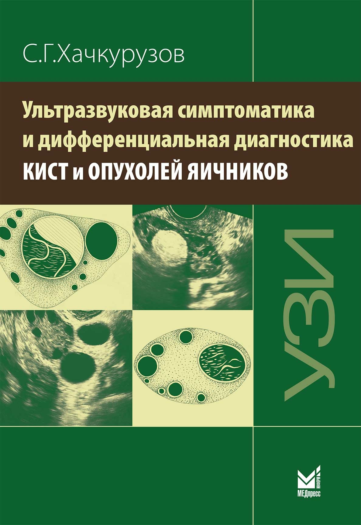 Хачкурузов С.Г. Ультразвуковая симптоматика и дифференциальная диагностика кист и опухолей яичников 