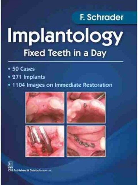 Schrader Implantology Fixed Teeth in A Day 