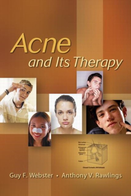 Webster Guy F Acne And Its Therapy 