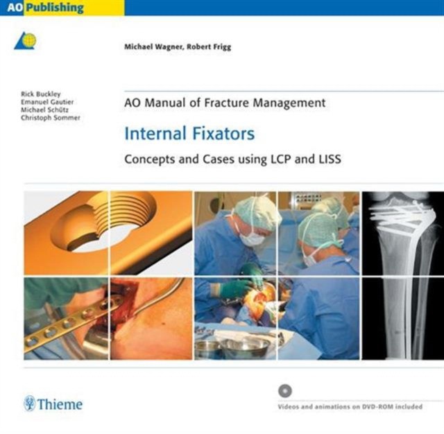 Michael Wagner AO Manual of Fracture Management: Internal Fixators - Concepts and Cases using LCP/LISS 