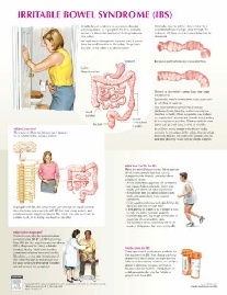Netter Frank H. Irritable Bowel Syndrome Chart Poster 