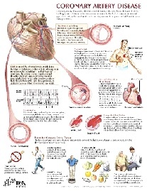Netter Frank H. Coronary Artery Disease Chart Poster 
